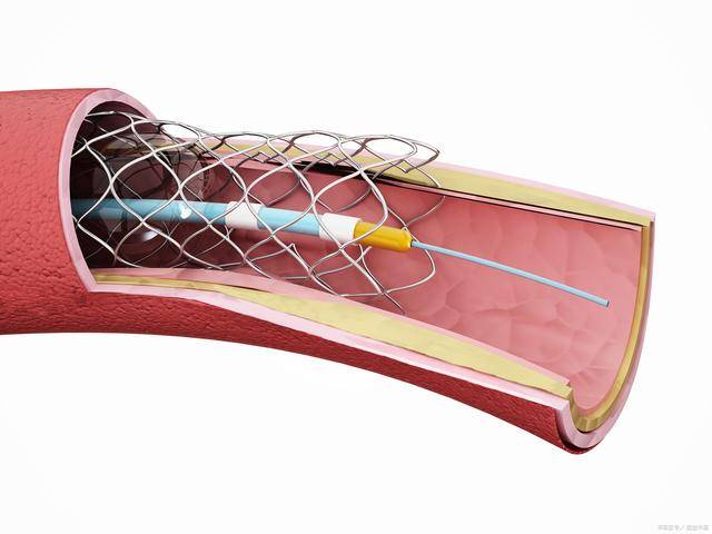 心脏支架球囊图片图片