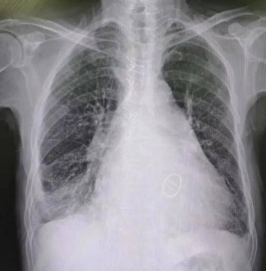 心衰突然加重,门诊转入icu,他在吉心获得"第二次生命"