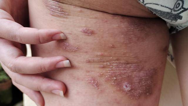 艾滋病患者经常出现皮疹,这是一种皮肤表面出现的异常红斑或丘疹