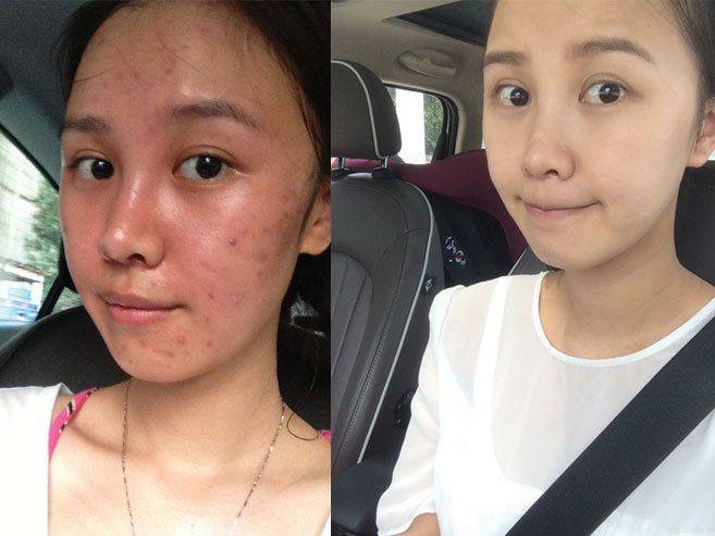 祛痘不难!闭口粉刺最有用的药膏前十名,总有一款适合你