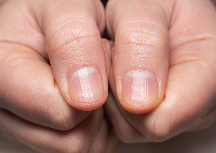 指甲很多竖条纹是什么原因(通过看指甲怎么知道身体有没有问题)