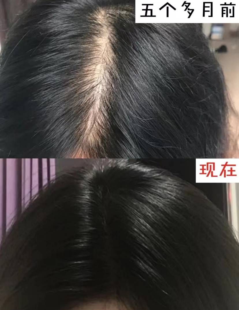 快来试我亲自验证的增发秘籍!_头发_头皮_效果