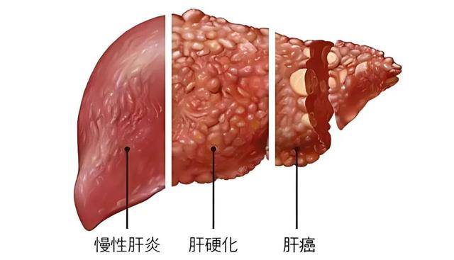 乙肝患者要滴酒不沾吗?哪些人易得肝癌