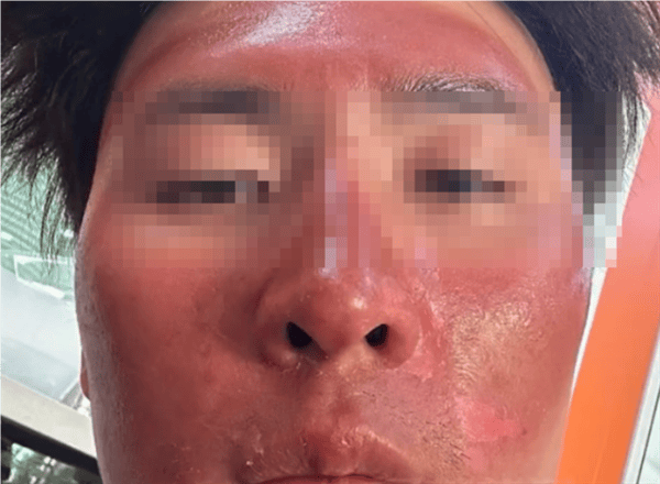 男子爬雪山晒伤成面膜脸:大面积流脓 脱皮_紫外线_脸部_进行