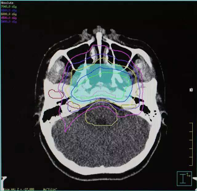 28岁女性鼻咽癌复发—质子治疗【携康就医指南】鼻咽癌出国治病
