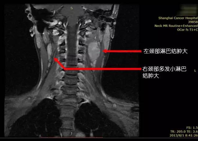 28岁女性鼻咽癌复发—质子治疗【携康就医指南】_患者_肿瘤_对比