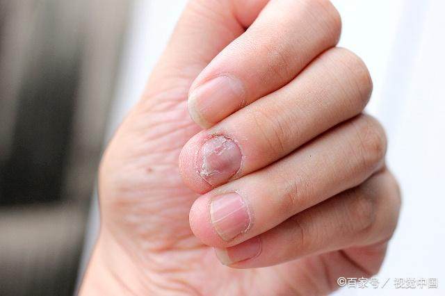 肝不好的人,手上可能会出现这4个"变化",你留意了吗?
