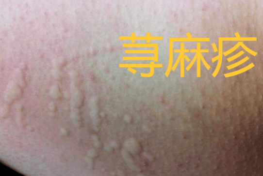【皮肤病课堂】生活中,如何应对身上长红色风团特别痒!