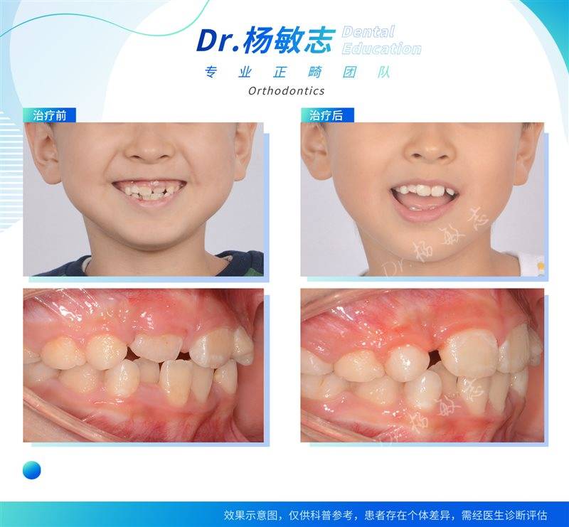 儿童颌骨矫正图片