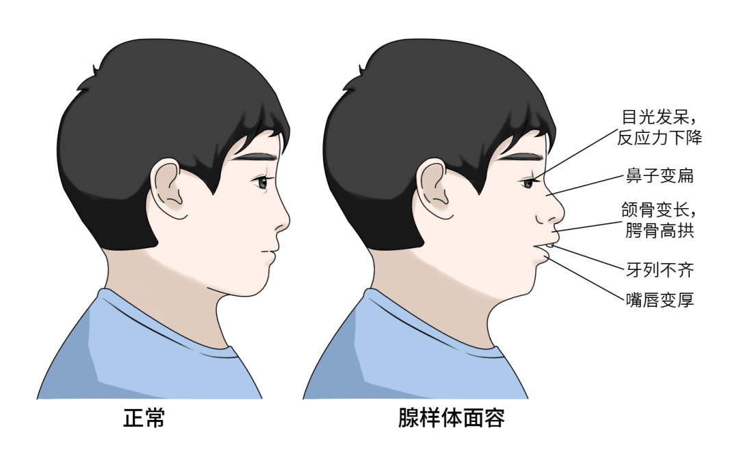 腺样体肥大的位置图片图片