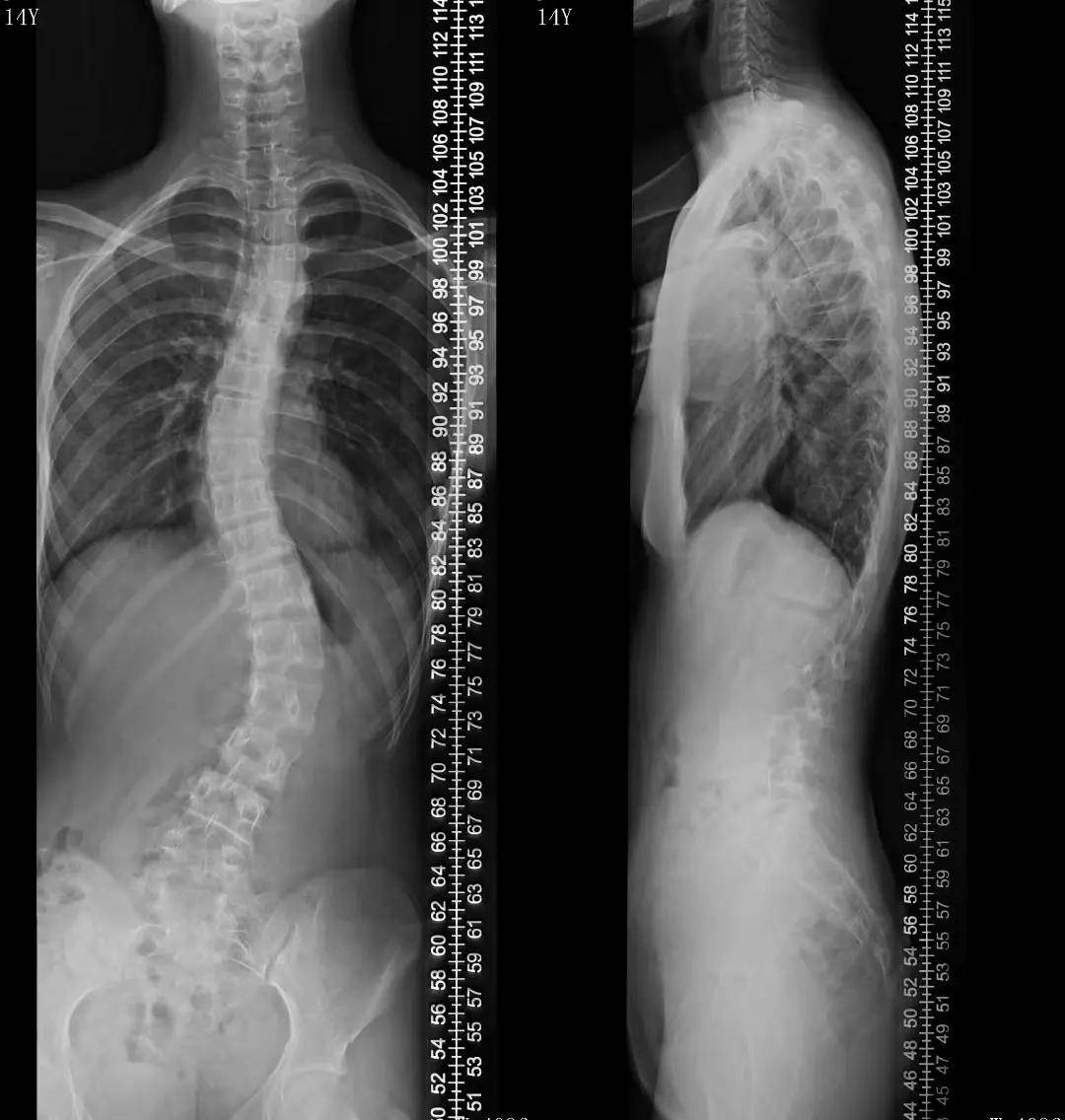 脊柱侧弯矫正