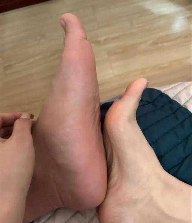 游泳队人均扁平足?网友感慨"和冠军有了相同点",医生:及时干预