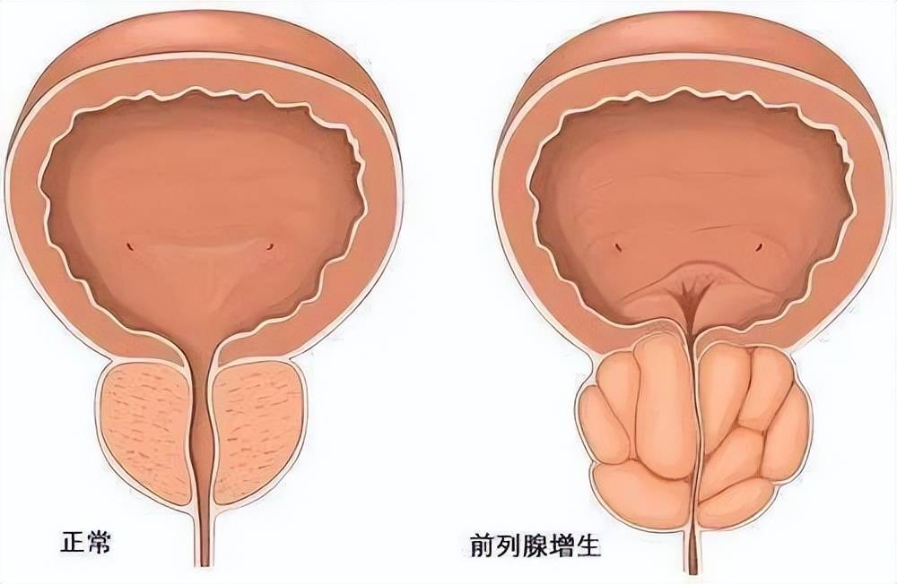 受性激素的调控,前列腺间质细胞和腙上皮细胞相互影响,随年龄增大体內