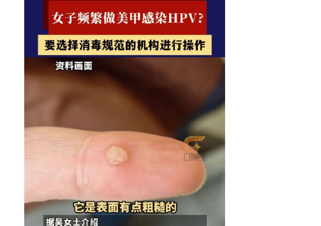 武汉一女子频繁美甲感染hpv,病毒疣大多是由hpv感染引起的