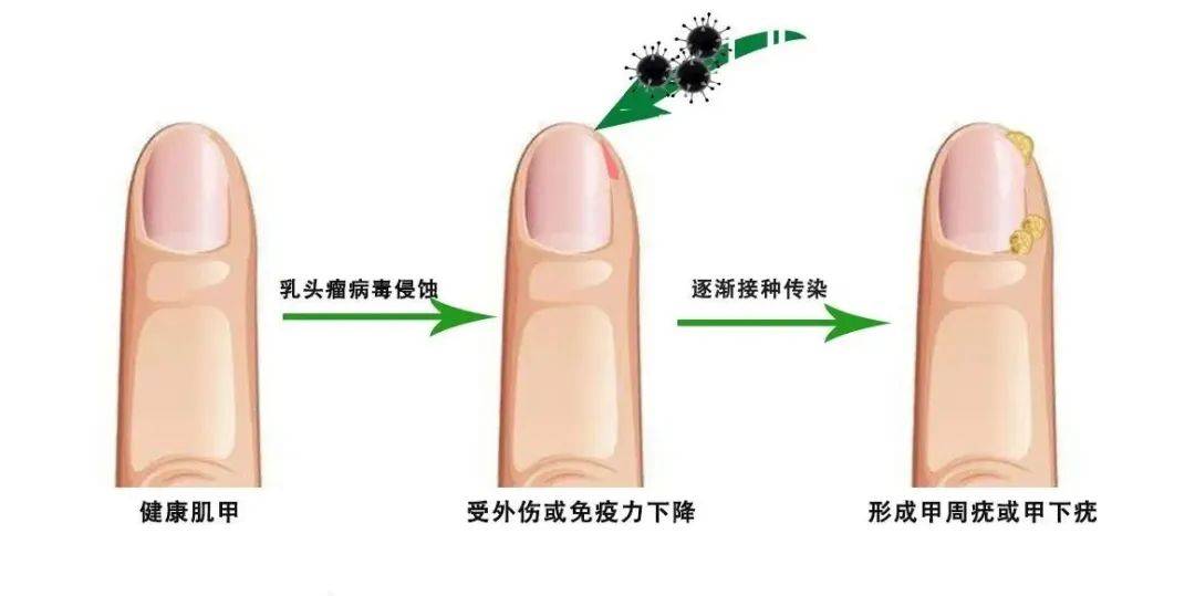 【健康科普】甲周疣的病因揭秘 病毒感染是元凶