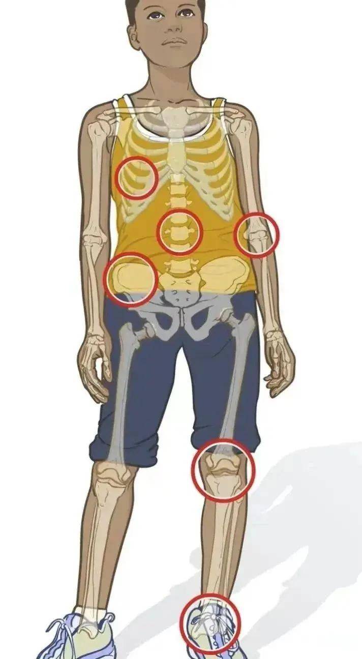 少年肋骨上鼓个包,带你认识下肋骨软骨瘤