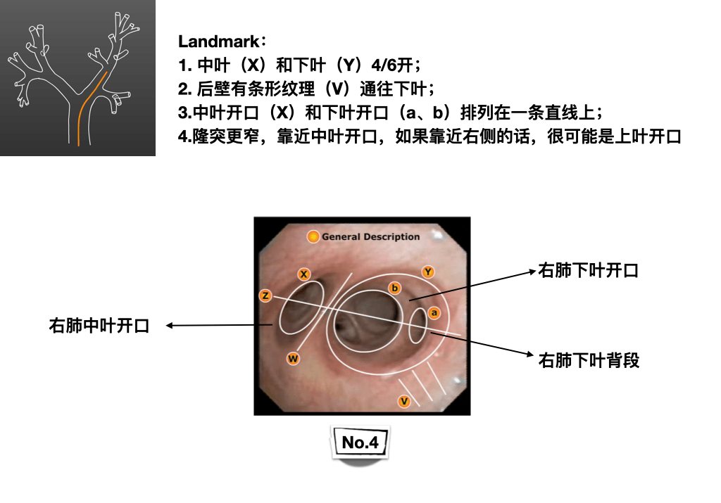 临床必备|纤维支气管镜入门图谱,一文分享!超实用!