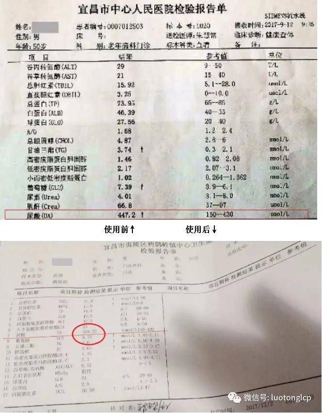 高尿酸检查报告图片图片