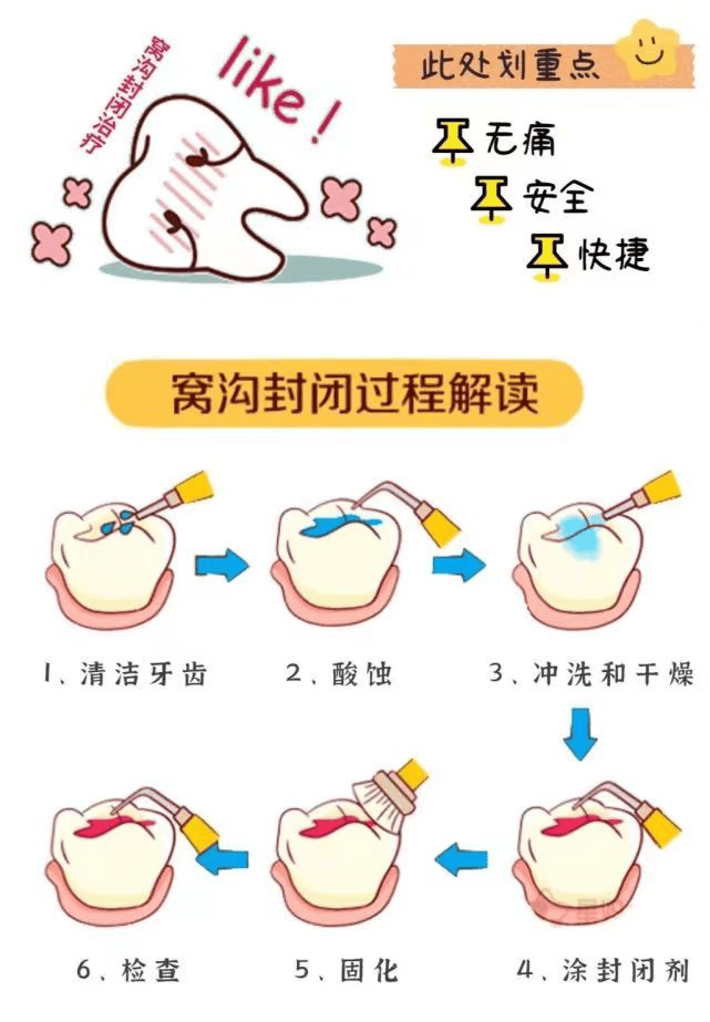 窝沟封闭漫画图片