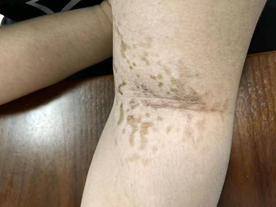 为啥我变胖了,这里还变黑了?医生:还能治!