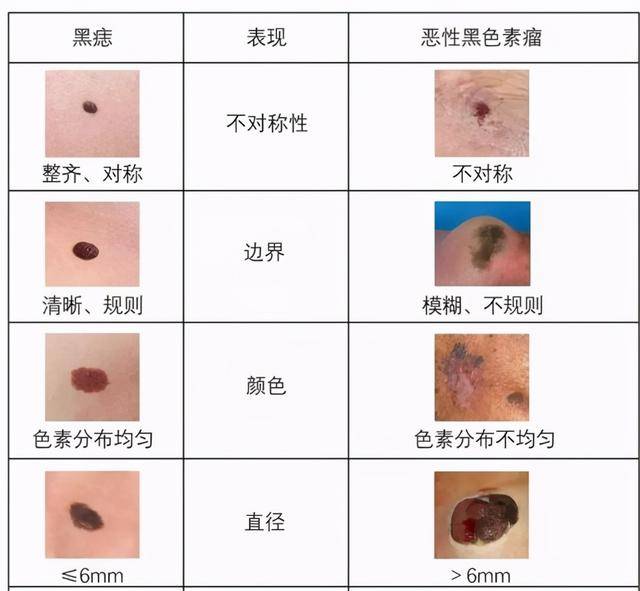 成都平安肿瘤医院赵春天主任 发现自己长了这种状态的痣……别犹豫