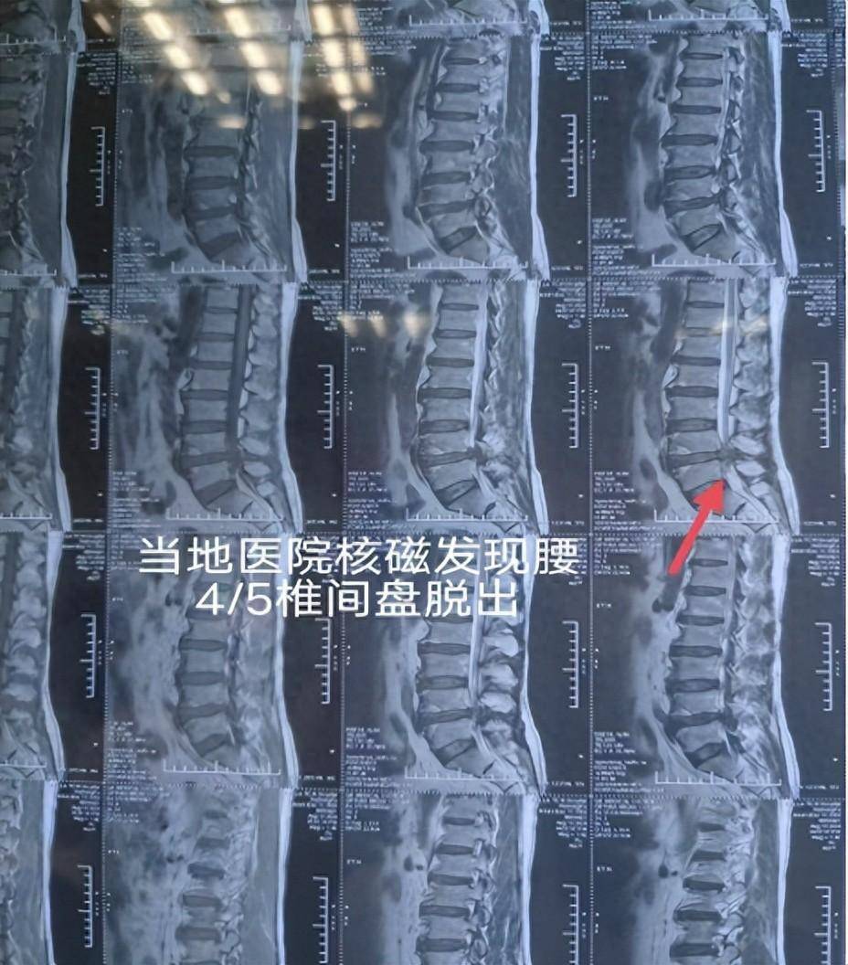 男子腰椎间盘突出竟引发大小便功能异常?罪魁祸首竟是马尾综合征