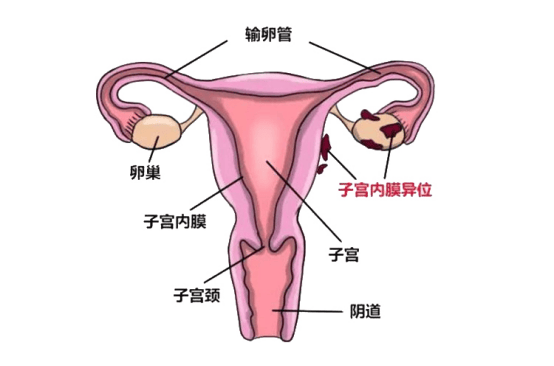 生长在子宫腔与子宫肌层以外的部位