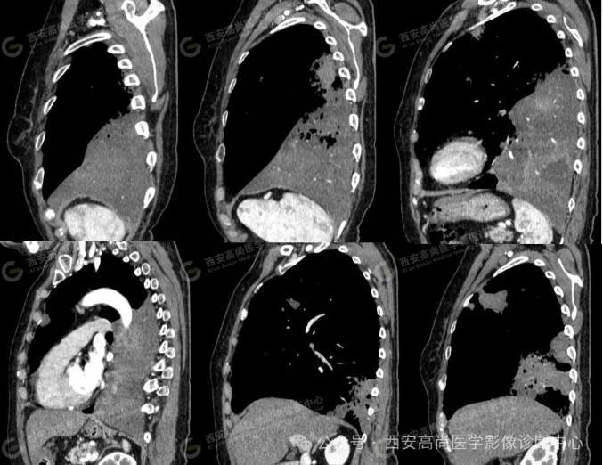 女,63岁,肺粘液腺癌一例