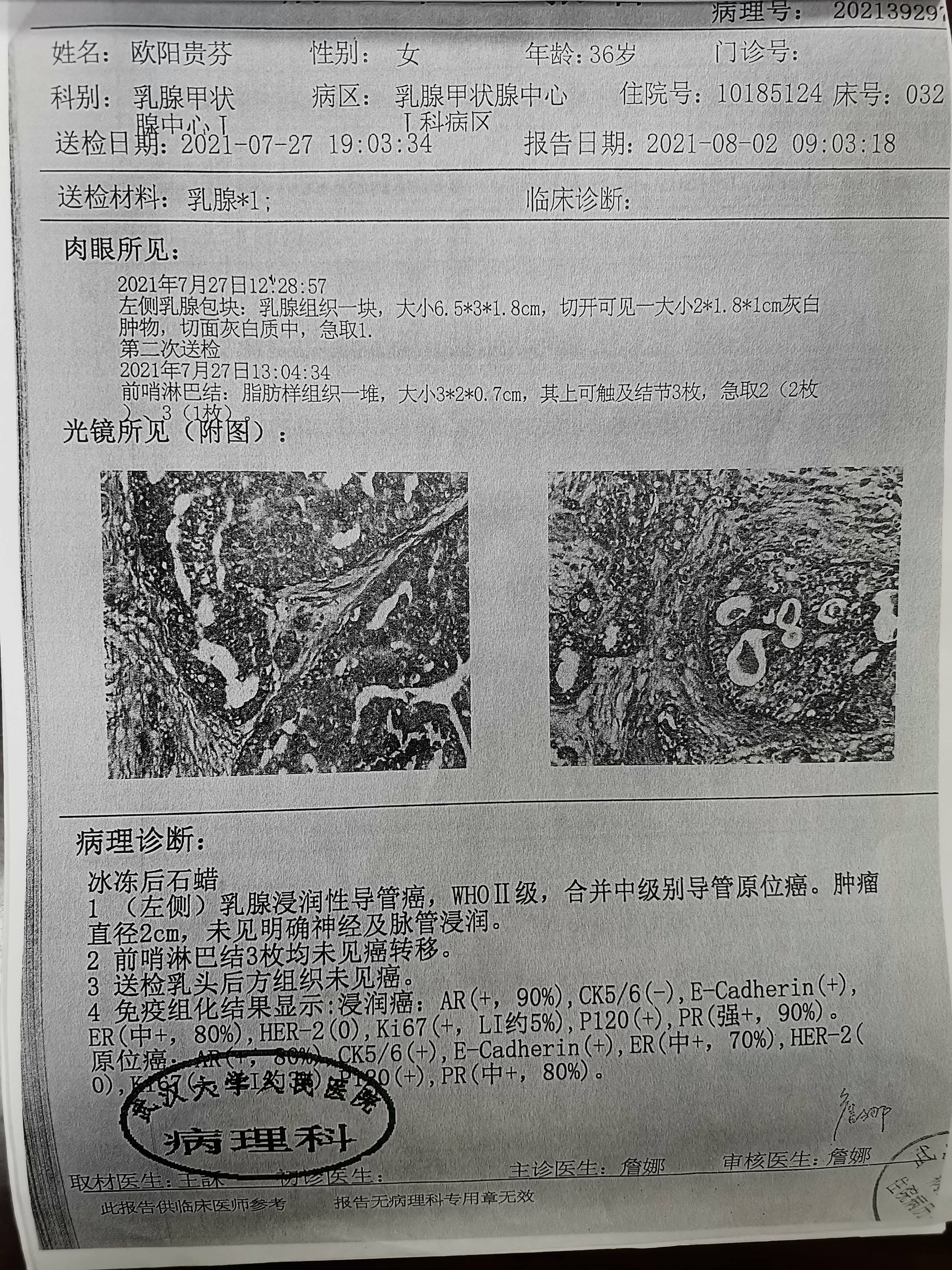 乳腺癌检查报告单图片