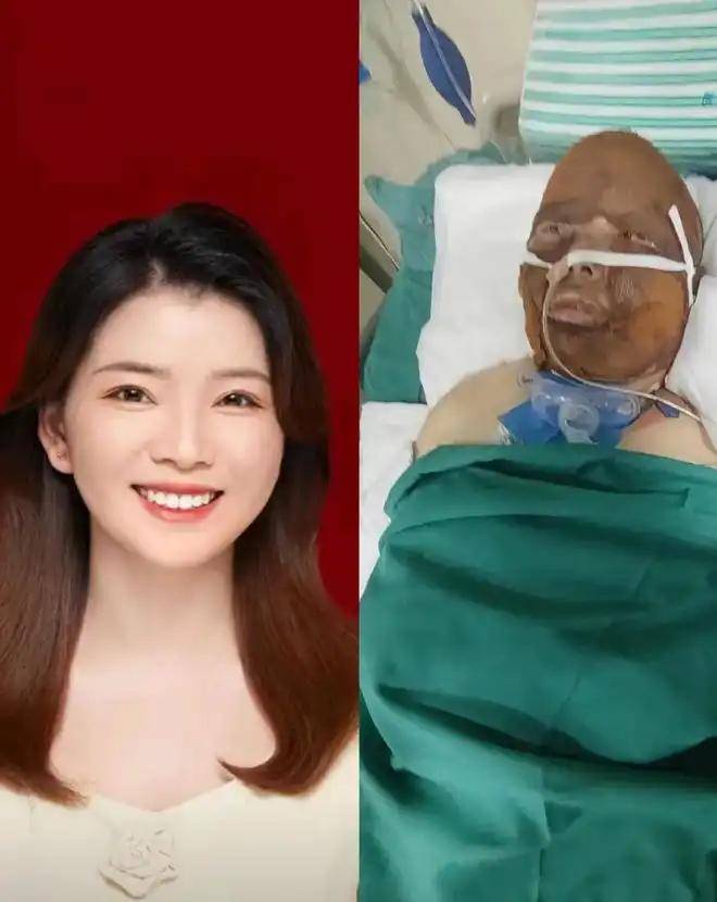 女子做饭煤气爆炸:严重烧伤第一时间确认孩子安全,病情曝光