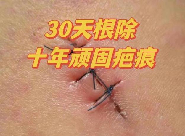 30天就能修复疤痕增生?过来人无偿分享自用妙招!效果绝了!