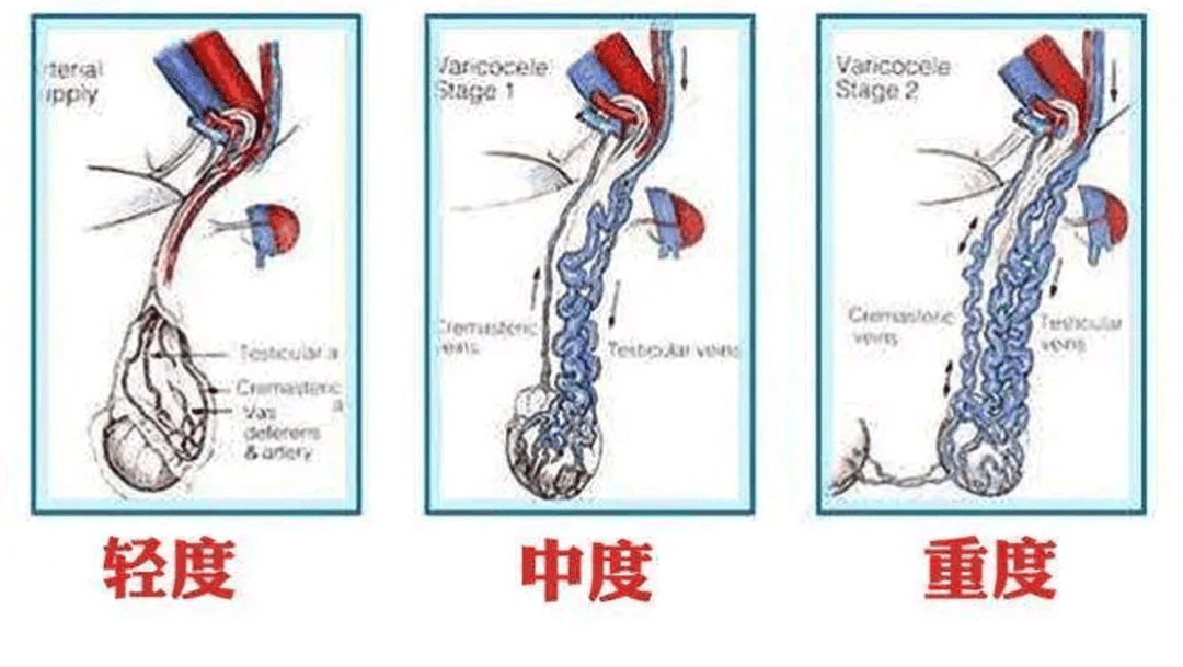 精索静脉曲张阴囊照片图片