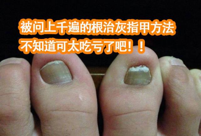 再次注意的时候是因为趾甲隐隐有些发痛,指甲也出现了增厚,掉渣,分层