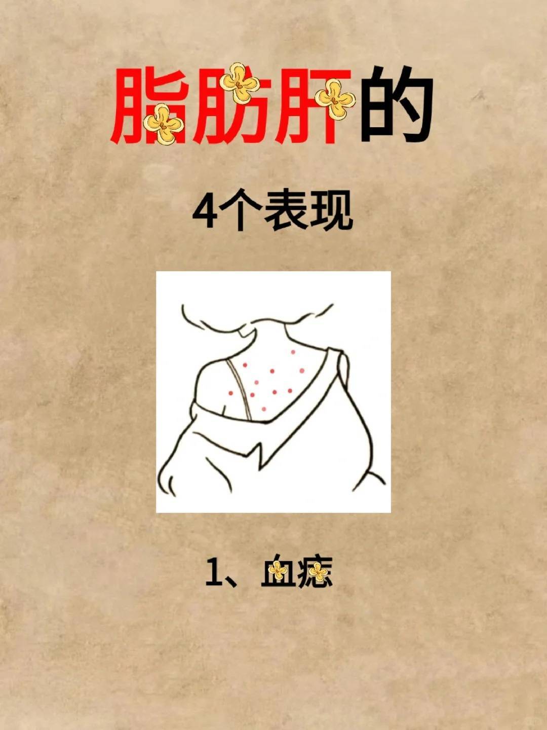 太原龙城中医医院科普:脂肪肝的4个表现