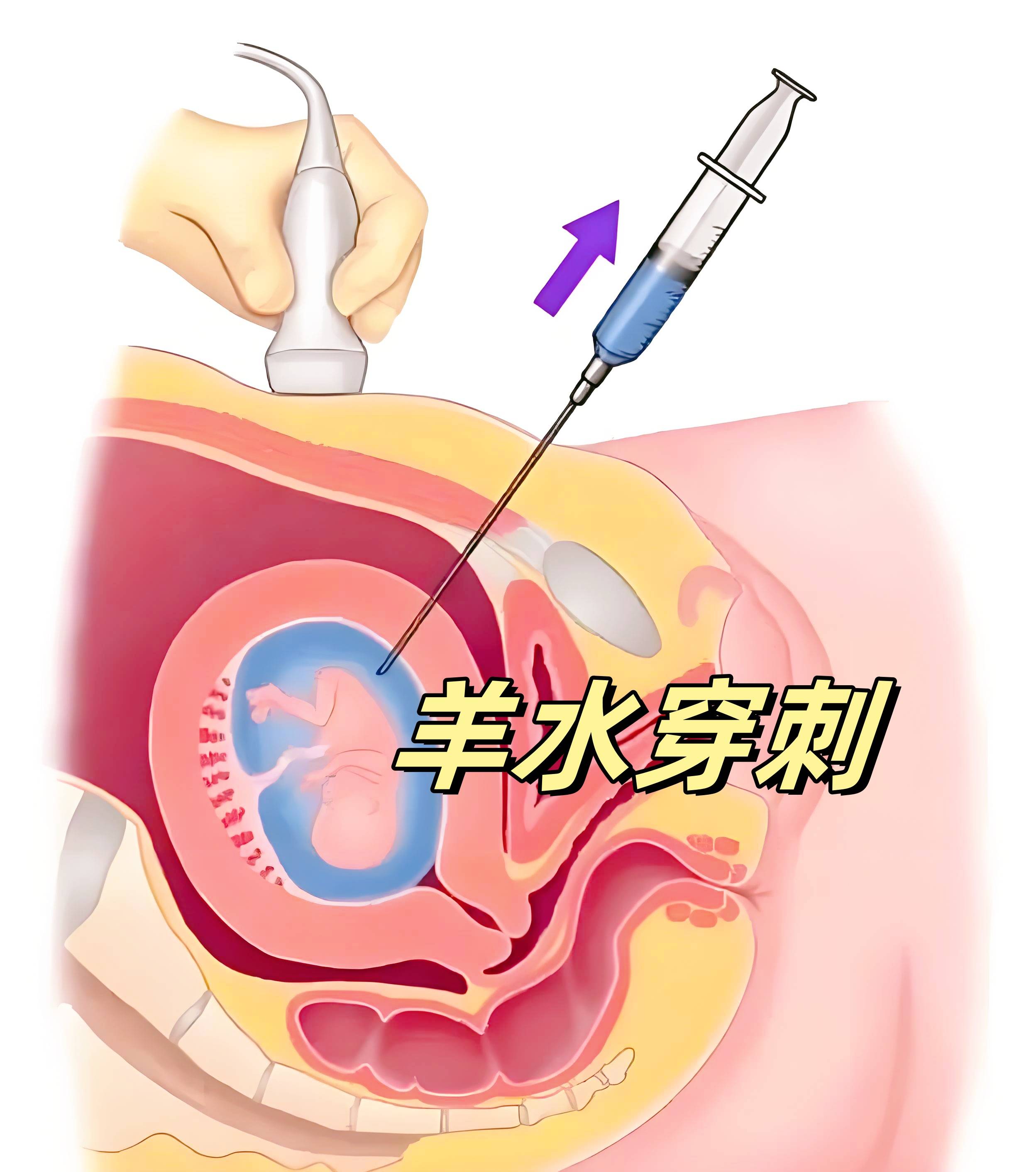 唐氏综合征为什么长一样？与这个原因有关系,爸妈要明白