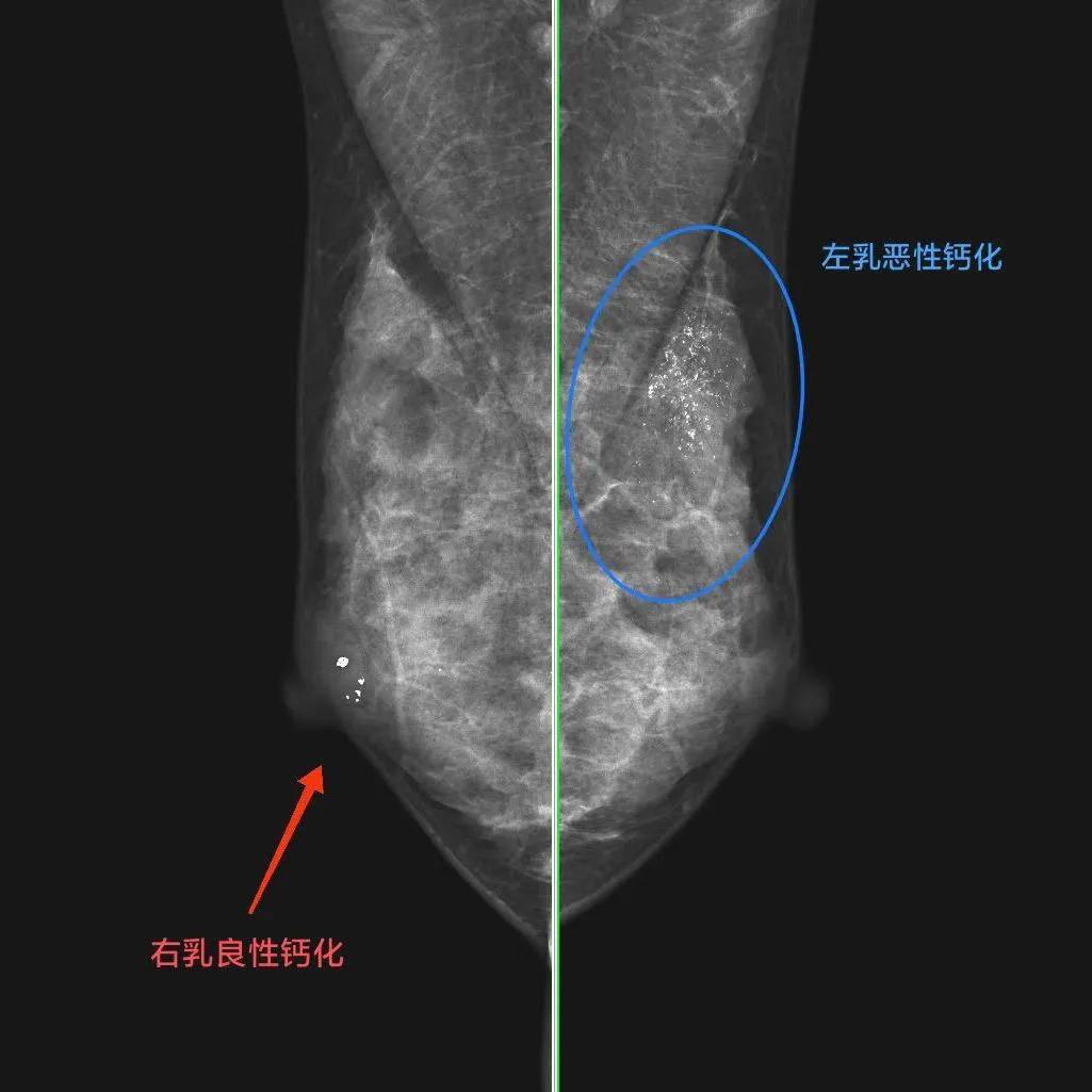 乳腺导管瘤的真人图片图片