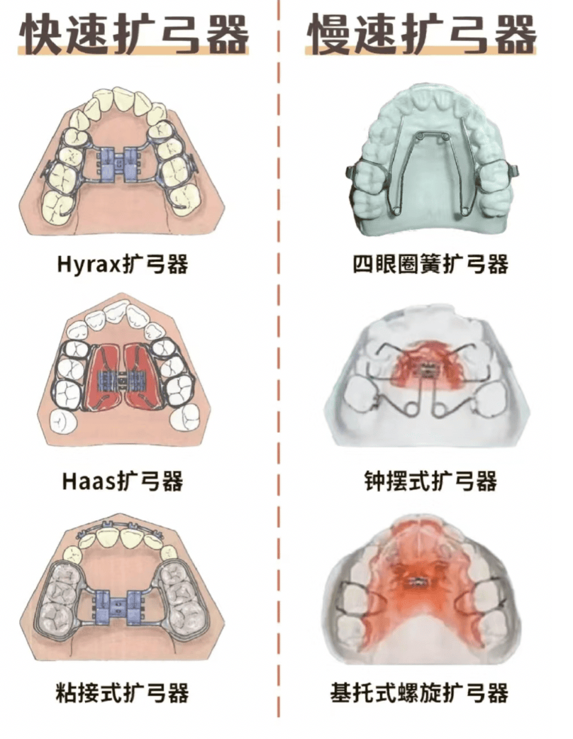 畸变示意图图片