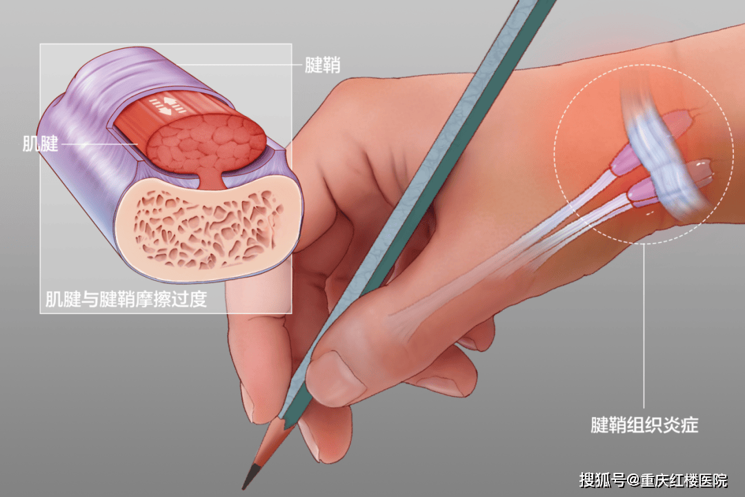 狭窄性腱鞘炎手术步骤图片