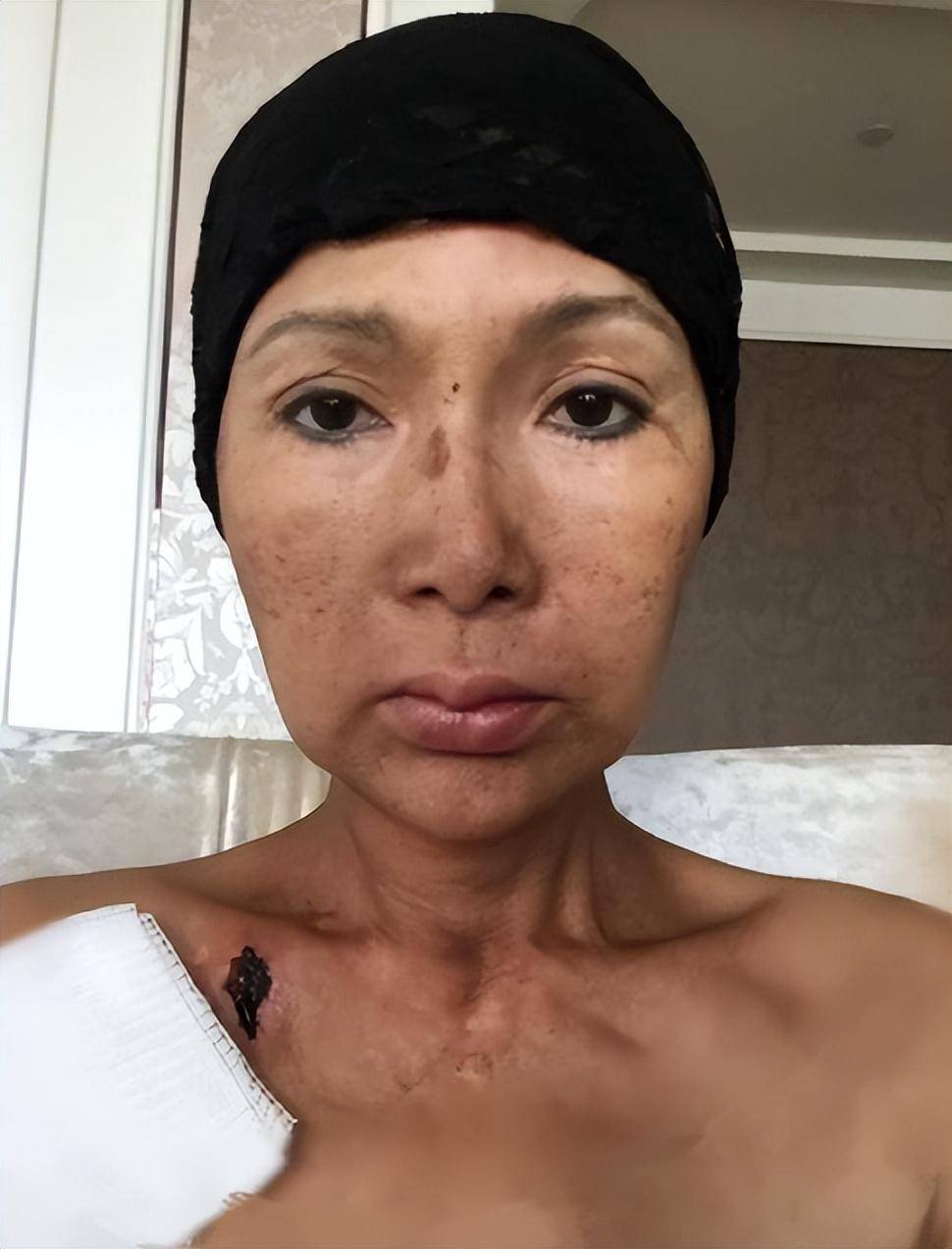 歌手张咪患上舌癌,为保命将切去一半舌头,已经是第三次患癌