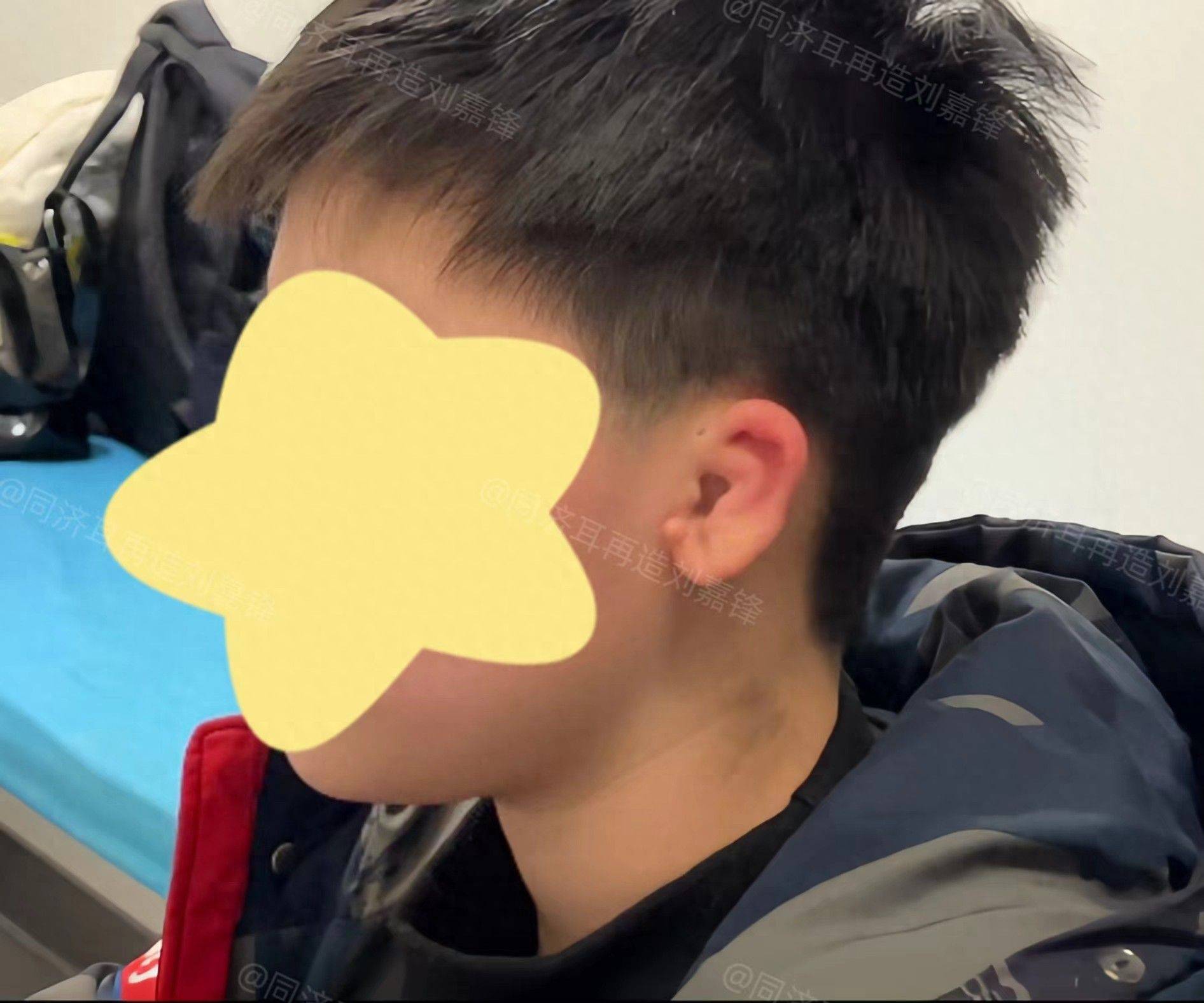 9岁男孩左耳畸形,都说要铲掉重做一个,父母四处求医找到新方案