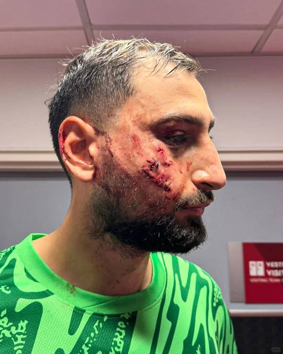 惨烈!多纳鲁马被爆头,米兰球迷也看不了吧