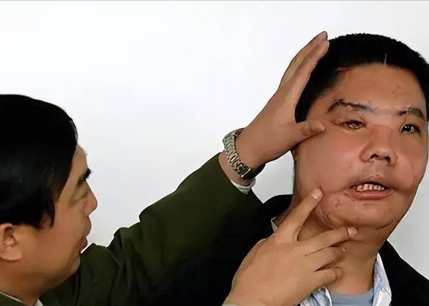 中国换脸第一人李国兴:被熊袭击面部,换脸手术成功半年离奇死亡