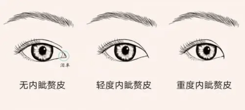 整形医生张耐洋:什么是内眦赘皮?形成原因及改善方法详解_手术_皮肤_内眼角