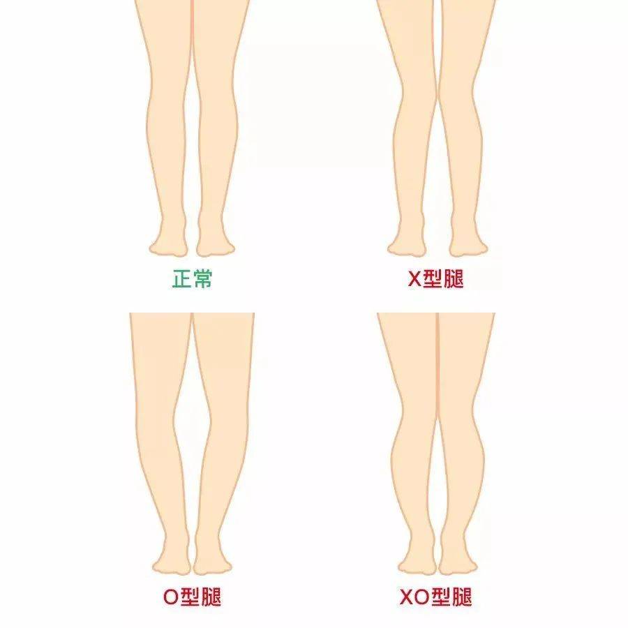 这时强行 "纠正",反而会对孩子造成更大伤害.真 x,o 型腿:这属于