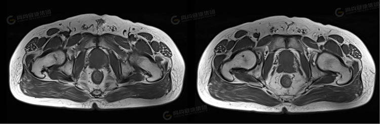 前列腺癌t4_前列腺癌t4n1m1生存期 火线

腺癌t4_火线

腺癌t4n1m1生存期「火线the wire」 行业资讯