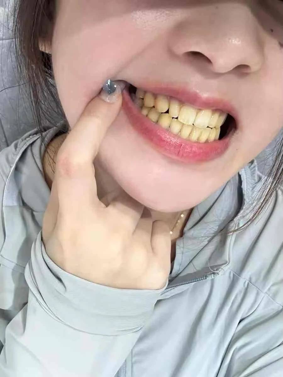 (对付大黄牙真的很有效)