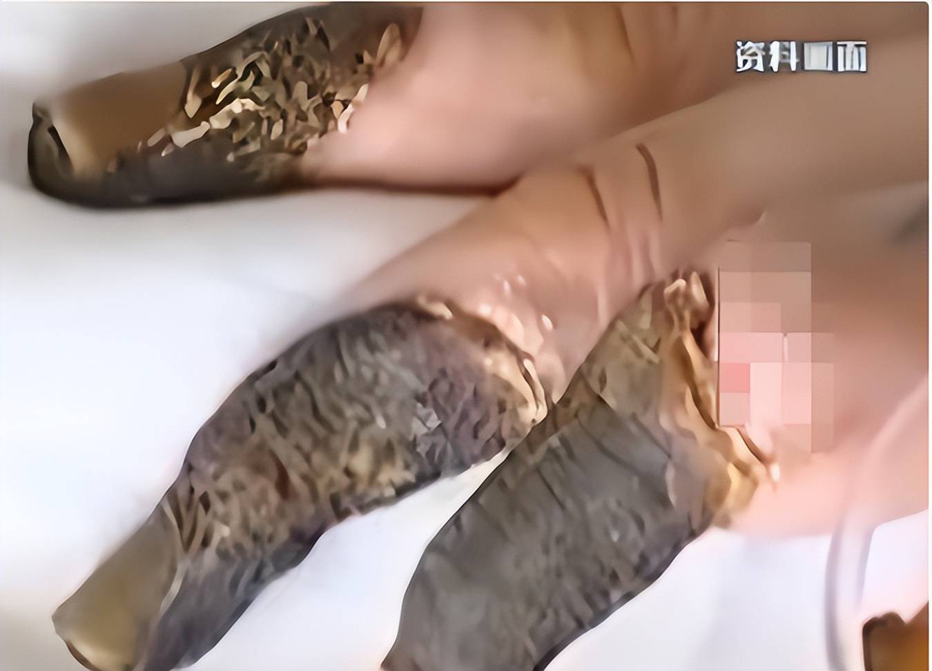 广东初二男孩将被截肢,右眼全瞎,网友:别忘了赔邻居钱!