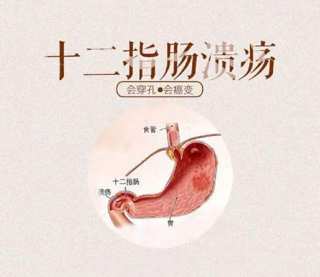 突然的腹痛，伴有恶心和呕吐，照顾十二指肠溃