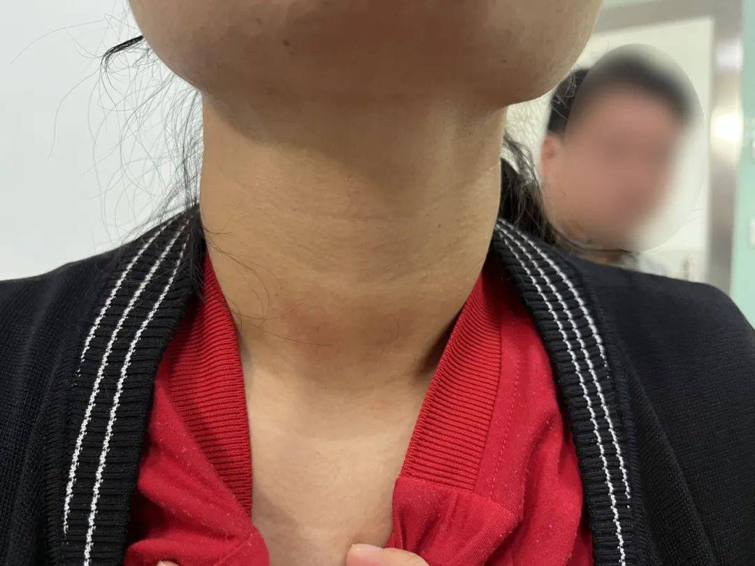 桥本氏甲状腺炎引起甲状腺弥漫性肿大桥本氏甲状腺炎要不要治疗