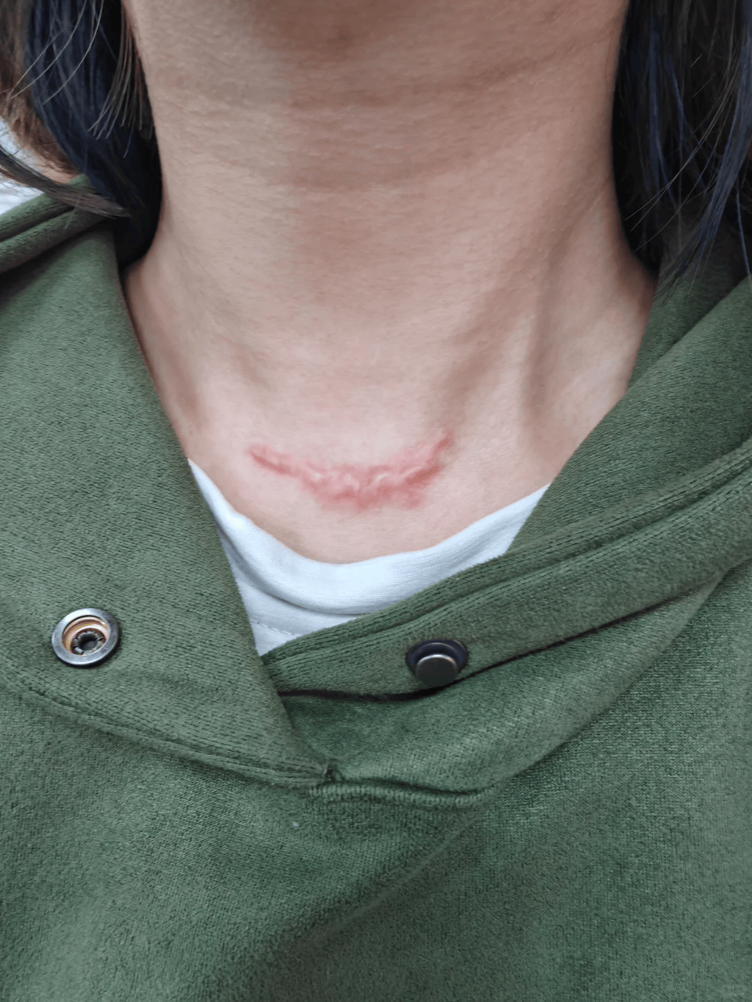 甲状腺手术疤痕又红又凸像蜈蚣3个月真实记录淡化过程